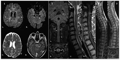 Atypical acute disseminated encephalomyelitis with systemic inflammation after a first dose of AztraZaneca COVID-19 vaccine. A case report